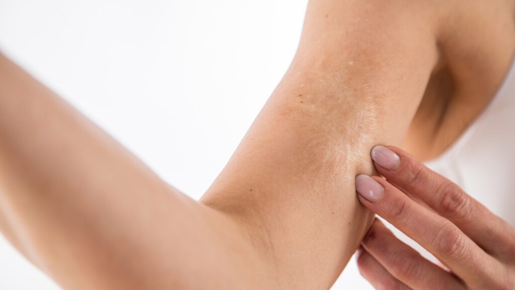 Narben ade: Die effektivsten Behandlungen für glatte Haut Narben ade