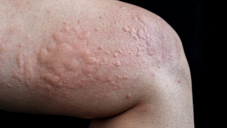 Eichenprozessionsspinner Ausschlag – Ursachen, Symptome und wirksame Hilfe verständlich erklärt häufigste todesursache französische bulldogge