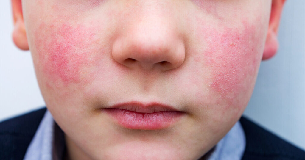 ringelröteln wie lange ansteckend