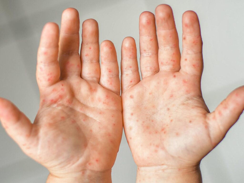 Krankheit Löcher in der Hand: Ursachen, Symptome, Behandlung und Warnzeichen krankheit löcher in der hand